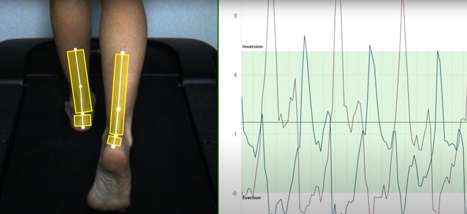 Analyse de la marche et de la course avec Clinique OPS