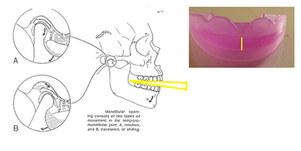 dimension verticale de la gouttiere