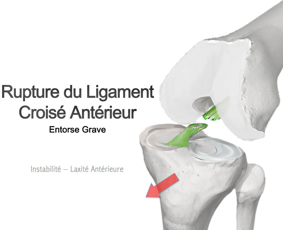 RUPTURE DU LIGAMENT CROISE ANTERIEUR : MECANISMES, FACTEURS CONTRIBUTIFS ET APPROCHES THERAPEUTIQUES