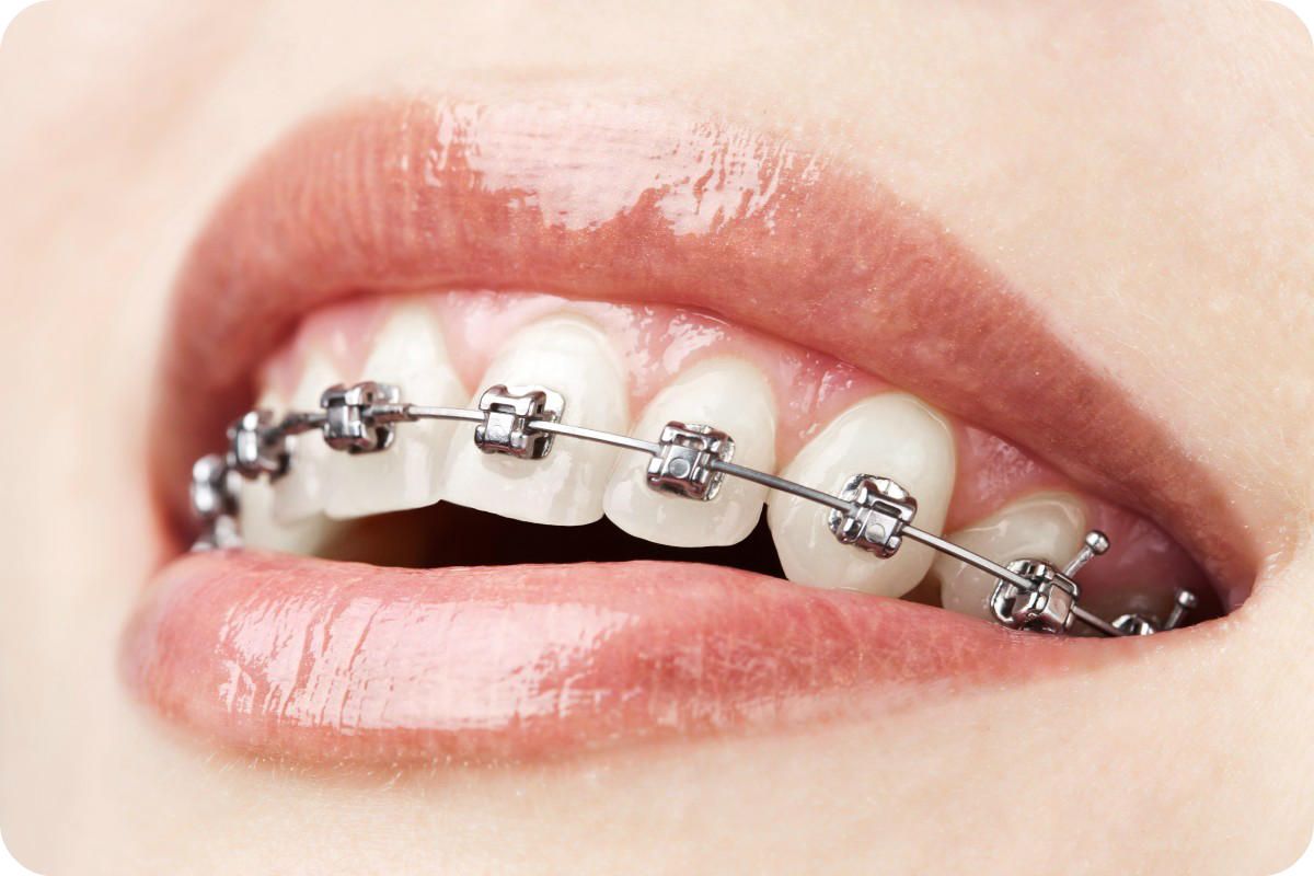 DE LA CONTRAINTE A LA CORRECTION ACTIVE : INTEGRATION DES ACTIVATEURS DENTAIRES AUX TRAITEMENTS ORTHODONTIQUES CLASSIQUES